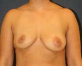 Feel Beautiful - Breast Asymmetry 106 - Before Photo